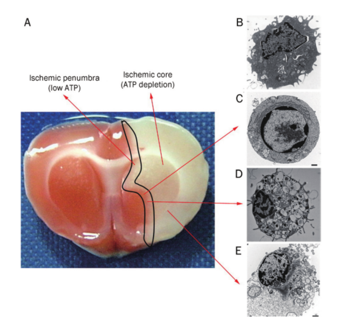  Necrosis, apoptosis and autophagy in focal cerebral ischemia. 